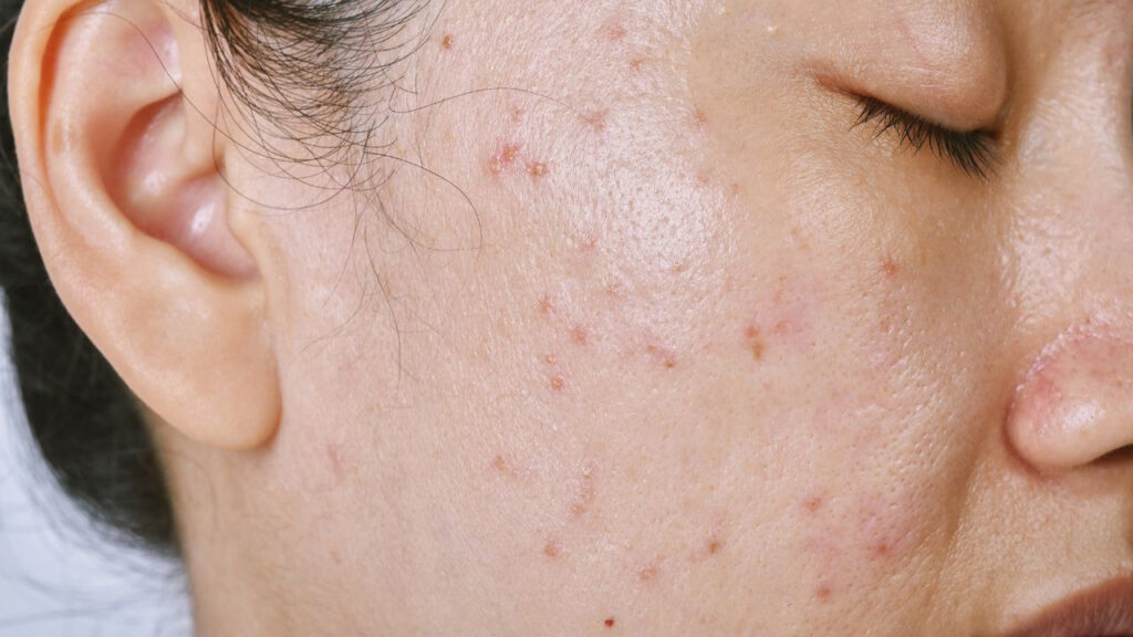 atrophic acne scars