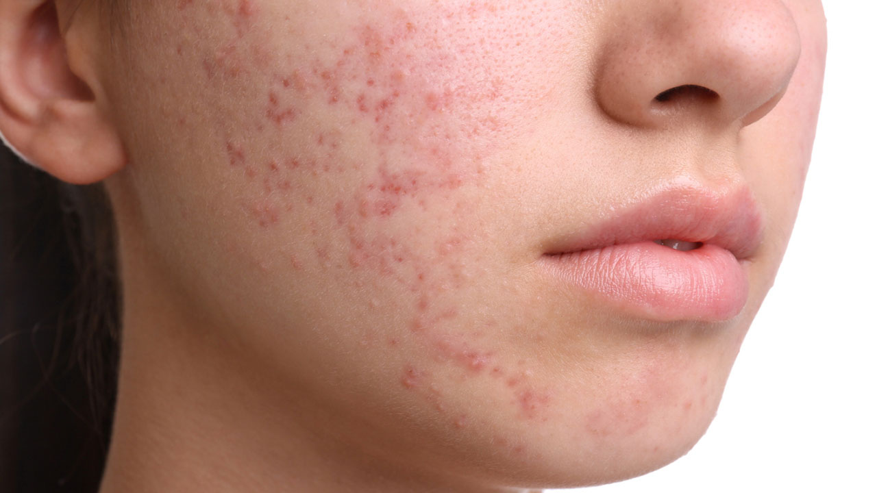 Pico Laser Work on Acne Scars