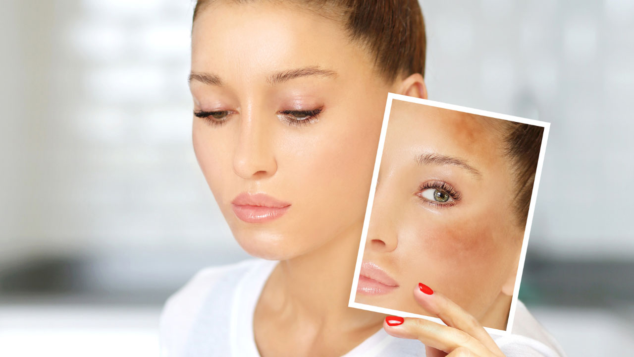 pico laser for hyperpigmentation