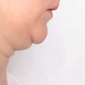 double chin facial treatment