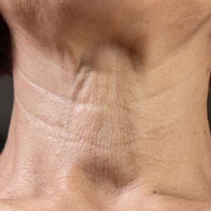 collagen production around the neck